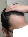 Early 20s Considering Minoxidil for Receding Hairline and Dandruff