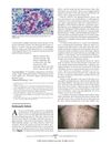 Postherpetic Poliosis