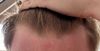 Advice on Receding Hairline and Finasteride Concerns (m24)
