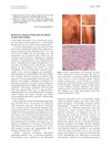 Refractory Cutaneous Lichenoid Sarcoidosis Treated with Tranilast