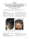Rare Presentation of Disseminated Follicular Lymphoma as an Ill-Defined Reticular Patch Over the Scalp and Forehead