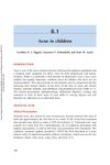 Acne in Children: Presentation and Treatment Overview