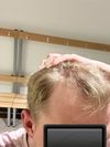 23M: Stalled Hair Growth at Hairline Despite Treatments