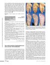 Successful Treatment of Palmoplantar Pustular Psoriasis with Brodalumab