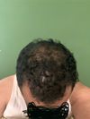 Seeking Advice for Crown &amp; Frontal Baldness, Hair Thinning – Should I Start Minoxidil &amp; Finasteride?