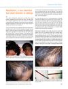 Monilethrix: A Rare Inherited Hair Shaft Disorder in Siblings