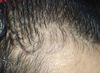 2 months of min + fin + ketokonazle