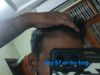 57th day on finestride 1mg