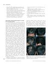 Diffuse Pattern Essential Syphilitic Alopecia: An Unusual Form of Secondary Syphilis