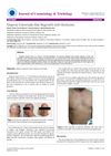 Alopecia Universalis Hair Regrowth with Hormones