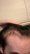 21M Considering Topical Fin or RU After Oral Minoxidil and Fin Reactions