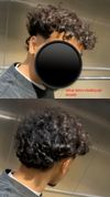 28M Experiencing Top Right and Left Side Hair Loss, Minoxidil Concerns, and Shedding in Humid Areas