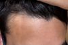 18M who noticed hairline retreat at 17.5