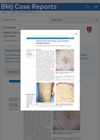 Patchy Hair Loss Over the Leg: A Case of Primary Follicular Mucinosis
