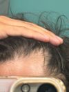 25M with Uneven Thinning Despite Oral Minox, Considering PRP and Microneedling