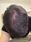19M on Minoxidil for 3 Weeks, Considering Finasteride Due to Recent Shedding