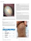 Micronutrient Deficiency and Protein-Calorie Malnutrition After Bariatric Surgery: Clinical Course and Outcome in Three Patients