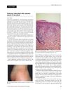 Multiple Minute Digitate Hyperkeratosis