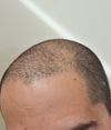 32M on Fin/Min for 2 Years: Considering HT for Overall Thinning