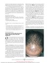 Finasteride Treatment May Not Prevent Telogen Effluvium After Minoxidil Withdrawal