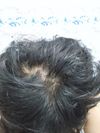 23M Experiencing Thinning at Crown/Mid Area; Minoxidil for 1 Month, Considering Finasteride
