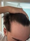 20-Year-Old Considering Finasteride After Hairline Change Post-Test
