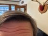 38M with TE: Struggling with Hair Loss, Seeking Advice on Fin/Min and Vitamins