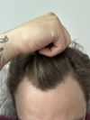 Norwood scale ? 28m