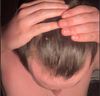28M: Continued Hair Loss on Dutasteride, Minoxidil Foam &amp; Keto Shampoo After 8 Months - Next Steps?