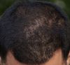 Weird Hair Loss Pattern – Worth a Biopsy?