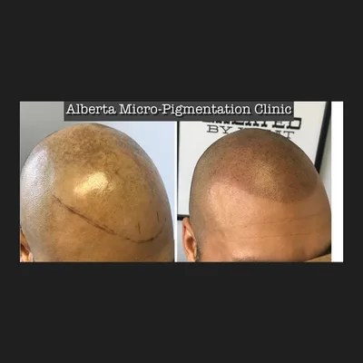 Alberta Micro-Pigmentation Clinic - Scalp Micro-Pigmentation (SMP)
