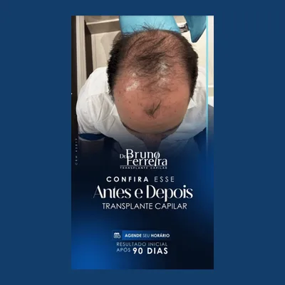 Transplante Capilar - Dr Bruno Ferreira