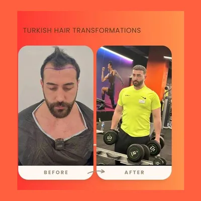 Turkish Hair Transformations