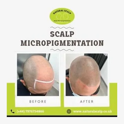 Natural Scalp