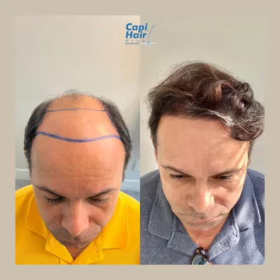Capi Hair Plus - Transplante Capilar no Rio de Janeiro