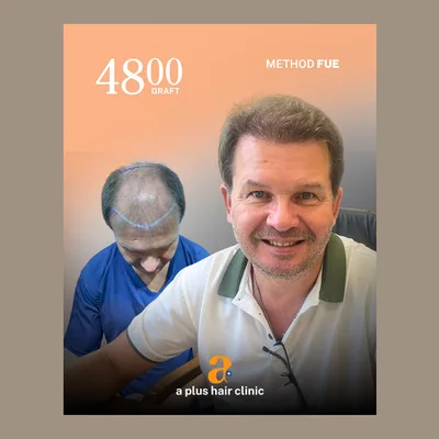 A Plus Hair Transplant
