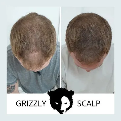 Grizzly Scalp - Scalp Micropigmentation