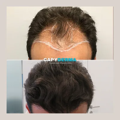 Capyderma