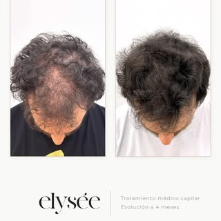 ✨ RECUPERANDO VOLUMEN Y SALUD CAPILAR: EVOLUCIÓN A 4 MESES

En Clínica Elysée, celebramos los result