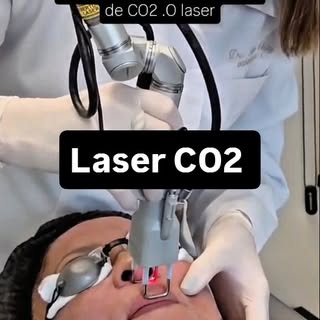 Inverno é a janela ideal para o laser de CO2 fracionado. Estímulo de colágeno, tratamento de rugas, 