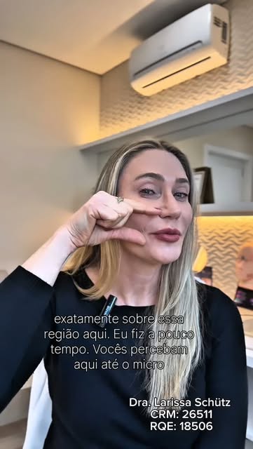 Sabia que os fios de PDO estimulam colágeno e ajudam a reduzir o bigode chinês e a flacidez facial, 