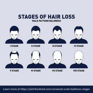 Hair loss is progressive, so early detection makes all the difference when it comes to hair restorat