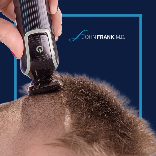 Traditional FUE hair transplants often mean shaving your whole head. But with Dr. John Frank, you do