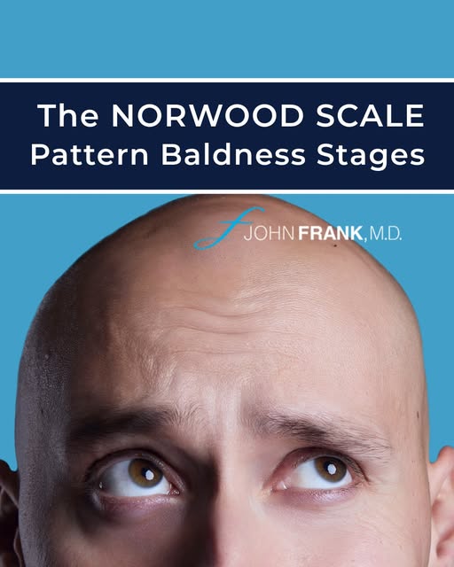 Balding rarely happens overnight. To evaluate the severity of #malepatternbaldness, specialists util