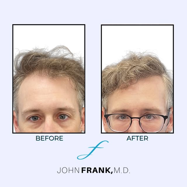 Notice the difference? Before, diffuse thinning left the scalp visible under direct light. Today, th
