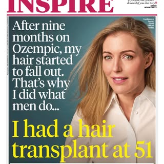 “My God mum, your hair is thinning…I can see your scalp” - and just like that, my hair transplant jo