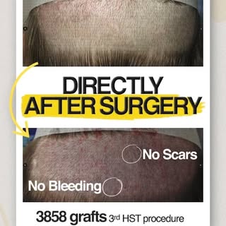 If you want a hair transplant that heals within 1 - 7 days, comment "REGROW" and you'll recieve a le