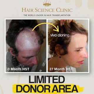 "There's nothing more we can do."

If you've heard that about your hair, you're in the group most cl
