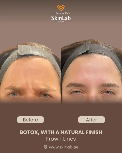 Smooth the lines. Keep the expression. ✨

Botox doesn’t have to mean looking “frozen.” 
The goal her