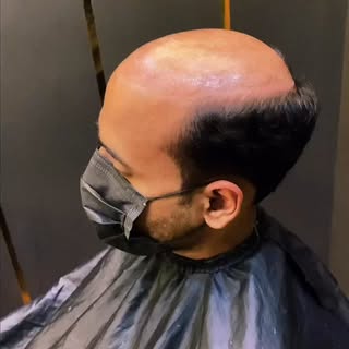 Experience the Premium Hair Patch for Men — crafted for a natural look, unmatched comfort & effortle